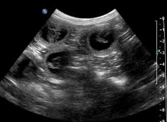 Ultrasound